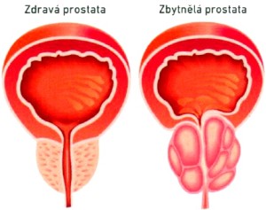 Zdravá a zvětšená prostata